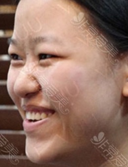 韩国崔宇景医生切开双眼皮+鼻综合矫正案例前后对比照片