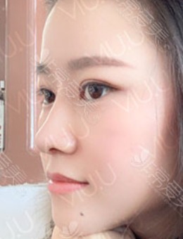 韩国崔宇景医生切开双眼皮+鼻综合矫正日记前后对比照片