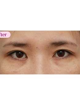 日本高须美容整形外科开眼角修复6个月恢复照片_术后