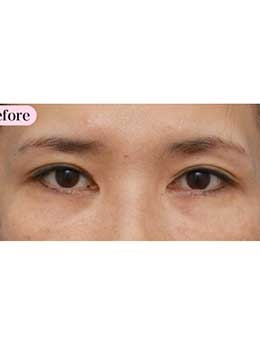 日本高须美容整形外科开眼角修复6个月恢复照片
