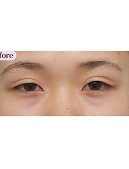 日本高须克弥眼部修复手术真人日记，内附前后恢复对比照片！