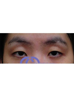 韩国碧夏整形医院眼部手术对比案例