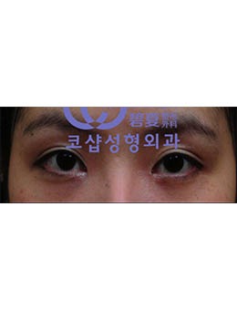 -韩国碧夏整形医院眼部手术对比案例