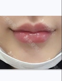 韩国Beautybar医院玻尿酸微笑线唇部整形案例对比_术后