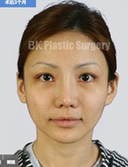 韩国BK整形外科V-LINE整形前后对比照片
