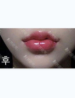 韩国dressps整形外科唇部整形案例