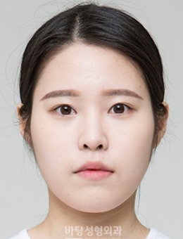 韩国芭堂整形外科医院下颌角整形案例对比图