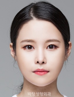 韩国芭堂整形外科医院下颌角整形案例对比图_术前