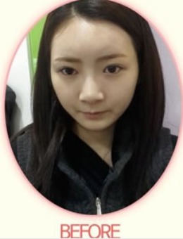 韩国秀美颜鼻部整形手术恢复日记