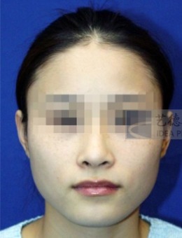 韩国艺德雅整形医院下颌角手术案例