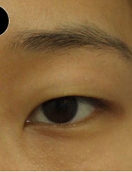 韩国SONE整形外科眼部手术对比案例_术后