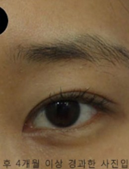 韩国SONE整形外科眼部手术对比案例_术前