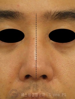 -韩国SONE整形外科男士鼻矫正手术对比案例