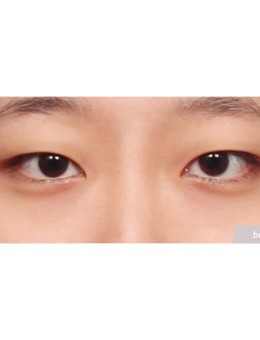 韩国ppeum整形外科眼部综合案例对比
