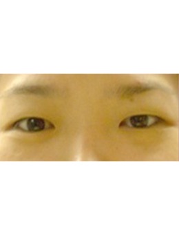 韩国美人制造整形外科眼部手术对比案例_术后