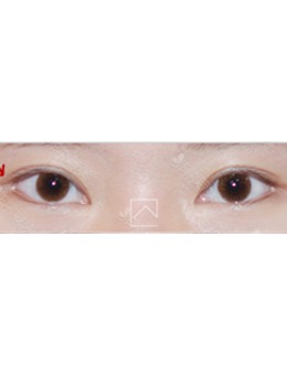 韩国misoline医院外眼角修复六个月效果