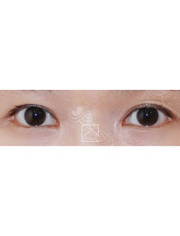 韩国misoline医院双眼皮疤痕修复对比_术前