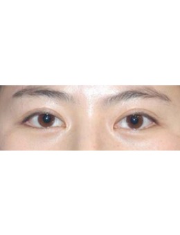 韩国李喜文埋线双眼皮修复案例对比
