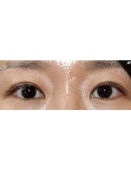 韩国初雪整形外科双眼皮修复日记对比_术前
