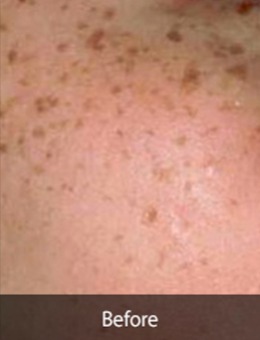 韩国延世starskin皮肤科面部祛斑手术案例