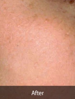 韩国延世starskin皮肤科面部祛斑手术案例