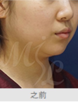 韩国modelline面部吸脂案例对比