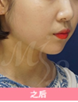 韩国modelline面部吸脂日记对比