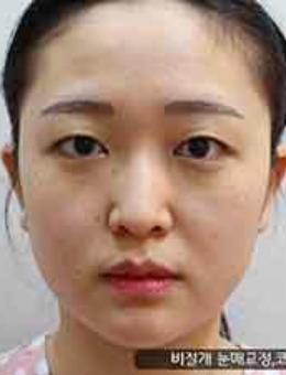 -韩国艾恩整形外科眼鼻矫正前后对比日记图