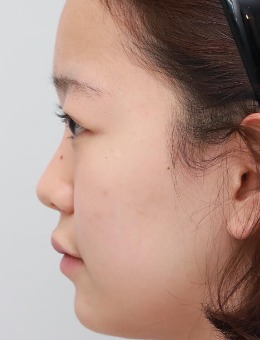 韩国艾恩整形医院-韩国艾恩整形misko隆鼻案例对比图