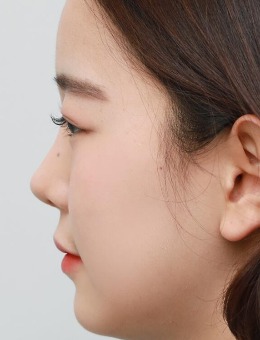 韩国艾恩整形医院-韩国艾恩整形misko隆鼻案例对比图