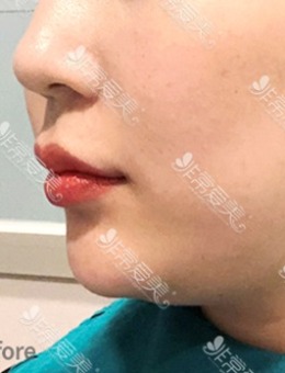 韩国DOCTORS皮肤科好莱坞面部提拉紧致手术案例对比_术后