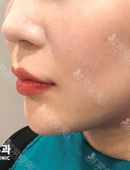 韩国DOCTORS皮肤科好莱坞面部提拉紧致手术案例对比_术前