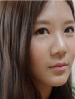 韩国美Plus整形外科真人假体隆鼻恢复过程案例