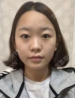 韩国艾恩医院鼻综合+面部脂肪填充7~15日恢复变化