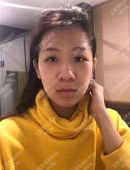 韩国艾恩手术日记：双眼皮+假体隆鼻让我抛弃“土妞”绰号