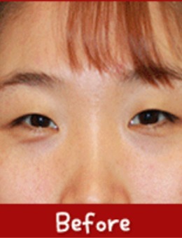 -韩国cube整形外科眼部手术案例