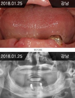 韩国来一菲牙科医院全口种植牙恢复案例_术前