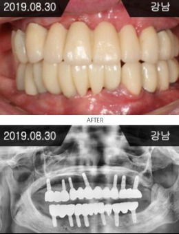 韩国来一菲牙科医院全口种植牙恢复日记