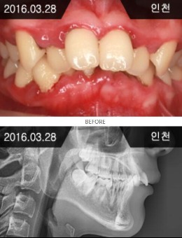 韩国来一菲牙科官网牙齿矫正前后对比案例图_术前