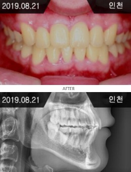 韩国来一菲牙科官网牙齿矫正前后对比案例图_术后