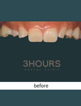 韩国三小时齿科全瓷牙贴片治疗前后对比案例图_术前