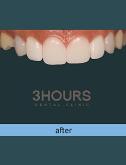 韩国三小时齿科全瓷牙贴片治疗前后对比案例图