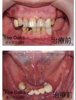 韩国橡树牙科医院做种植牙怎么样，官网种植案例曝光！_术前
