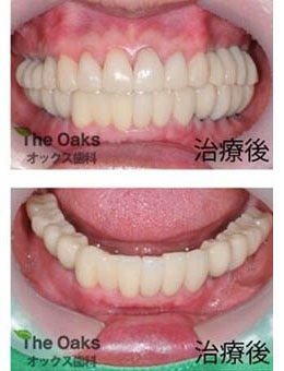 韩国橡树牙科医院做种植牙怎么样，官网种植案例曝光！_术后
