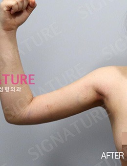 韩国Signature整形外科手臂吸脂前后对比案例_术后
