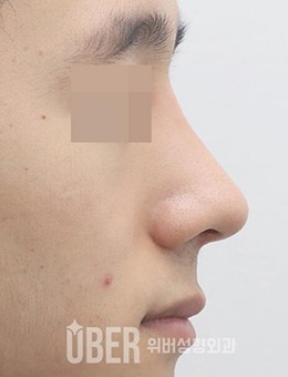 韩国玉芭uber整形外科鹰钩鼻矫正前后对比日记