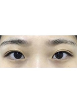 韩国GRIDA整形外科自然粘连法双眼皮日记，去韩国割双眼皮原来可以这么好看！