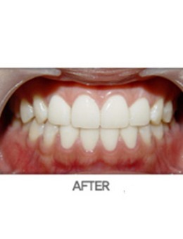 韩国牙齿贴面效果如何？韩国透明牙科医院牙齿瓷贴面案例值得一看！