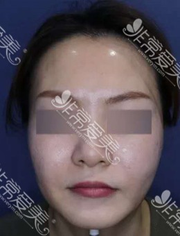 韩国施丽美羕皮肤科林萨郎院长做面部提升怎么样？来看真人案例对比图！_术前