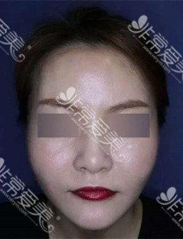 韩国施丽美羕皮肤科林萨郎院长做面部提升怎么样？来看真人案例对比图！_术后